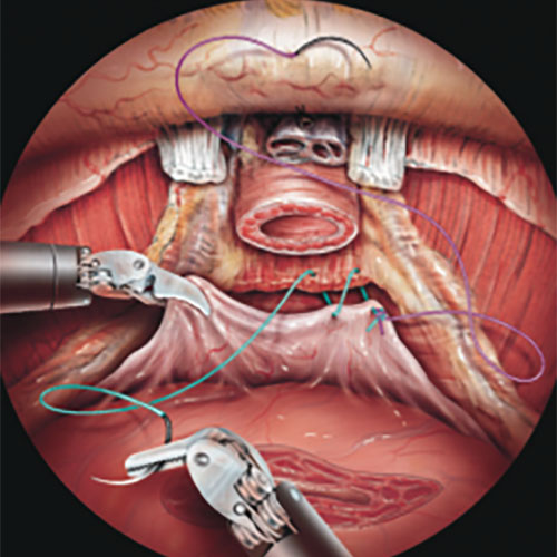 Robotic Prostatectomy