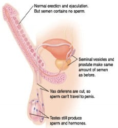 Vasectomy Side Effects Sexually Naked Pictures - aise.info