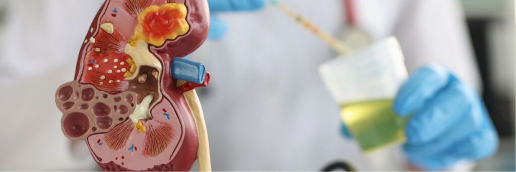 Hematuria means there is blood in your urine