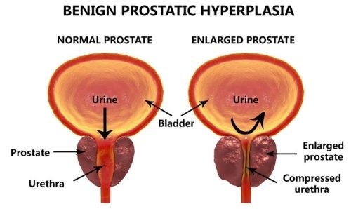 Benign prostatic hyperplasia diagram 1