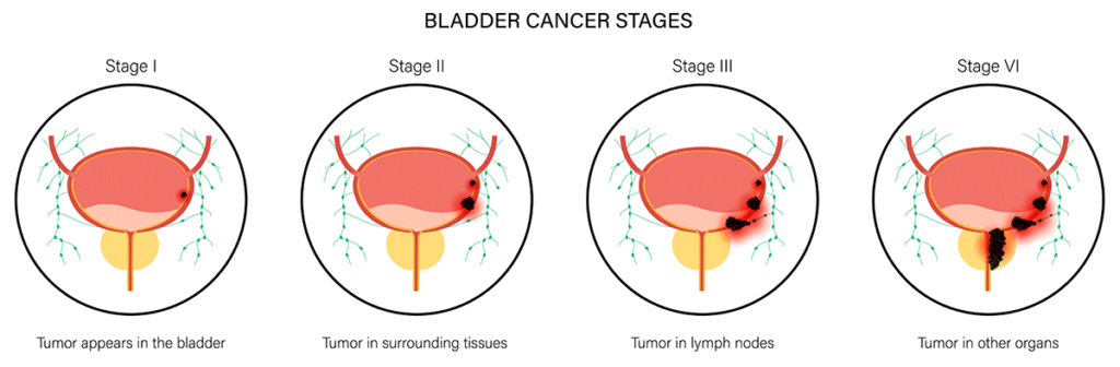 Stages of Bladder Cancer