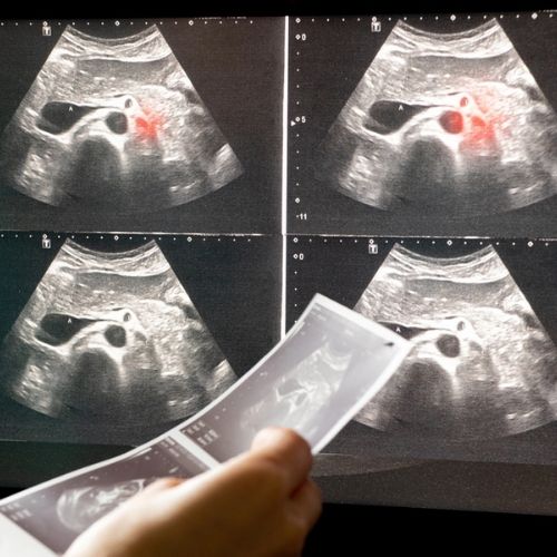 Bladder Scan