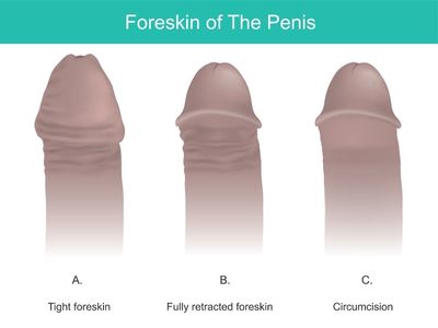 Foreskin Circumcision_Tower Urology