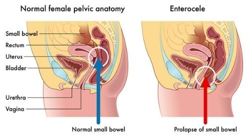 Pelvic Floor Prolapse Enterocele_ Tower Urology 1