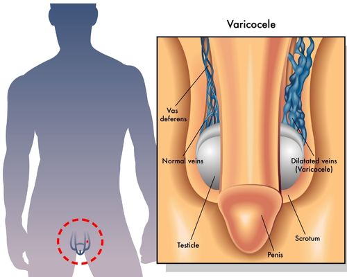 Penis Diagram Varicocele