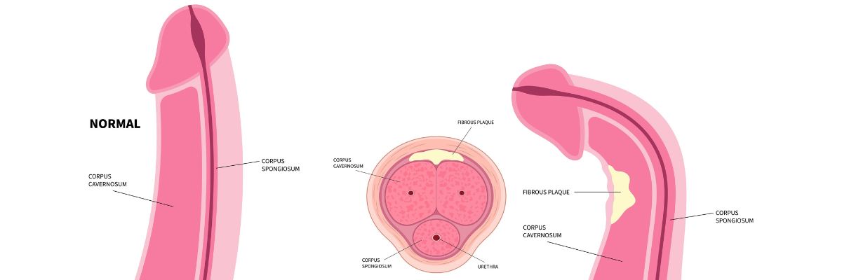 Peyronie's Disease penile curvature_Tower Urology 2