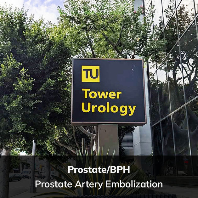 Prostate Artery Embolization,Tower Urology Los Angeles