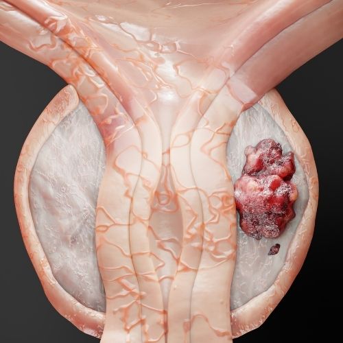 Prostate Cancer Biopsy, Tower Urology