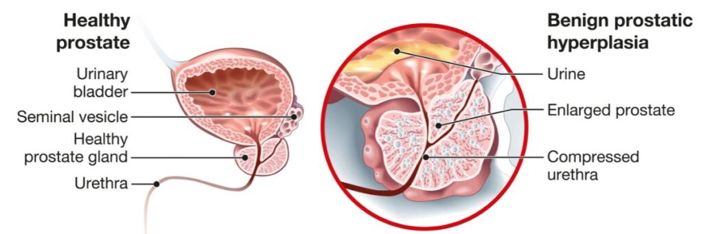 Prostate Cancer Diagram_Tower Urology