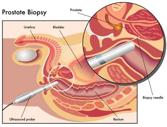 Prostate Biopsy Diagram