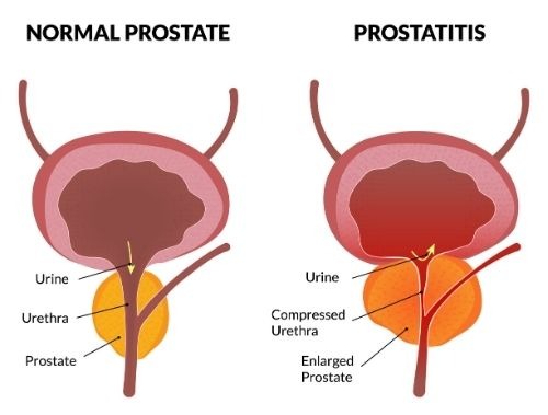 Prostatitis Diagram 2