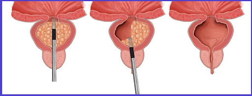 TURP-Procedure