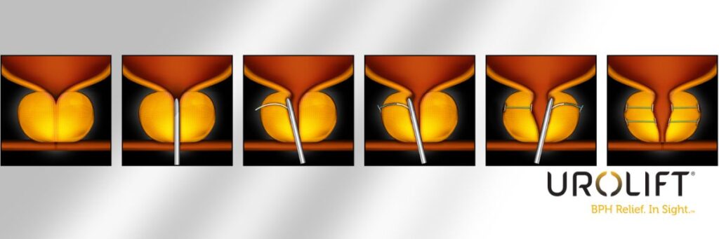 Urolift Procedure