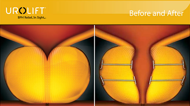 Urolift-featured2-3