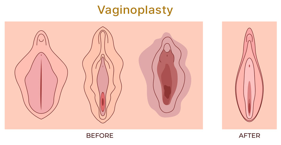 Vaginoplasty before and after