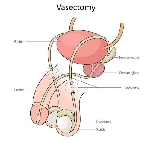 Vasectomy Diagram_Tower Urology_500x500