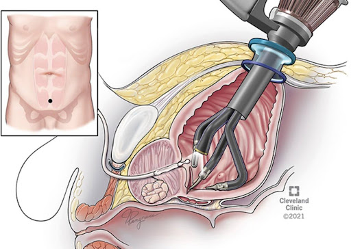 simple prostatectomy