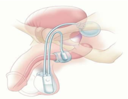 Artificial Urinary Sphincter
