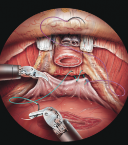 Robotic Prostatectomy
