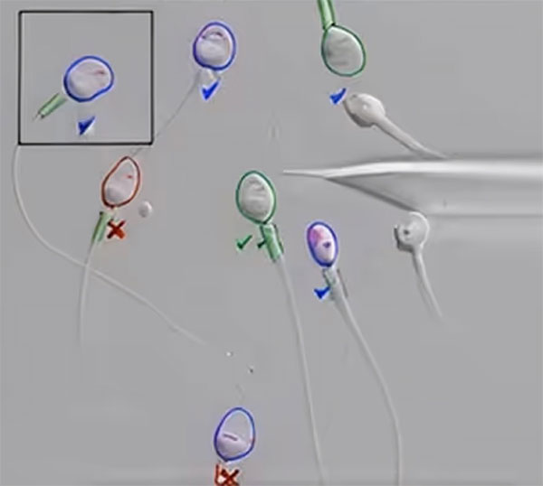 Semen Analysis Test Screen