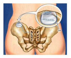 internal interstim