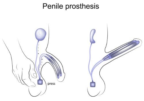 Penile Prosthesis Diagram 500x500