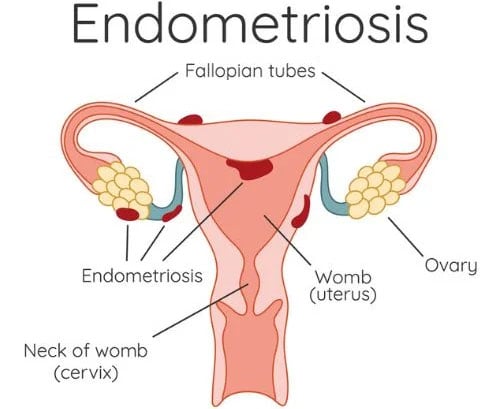Endometriosis Diagram