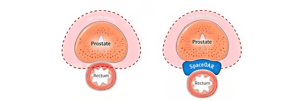 SpaceOAR Hydrogel_Tower Urology
